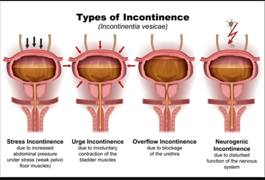 Urinary Incontinence Chart